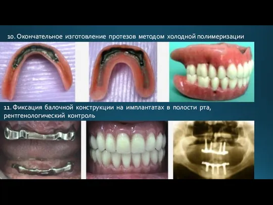 10. Окончательное изготовление протезов методом холодной полимеризации 11. Фиксация балочной конструкции