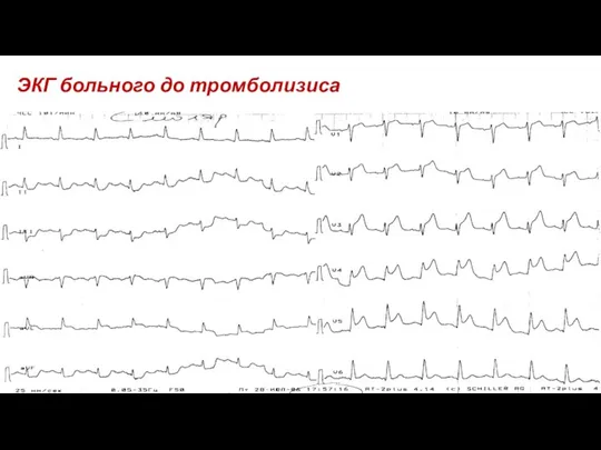 ЭКГ больного до тромболизиса