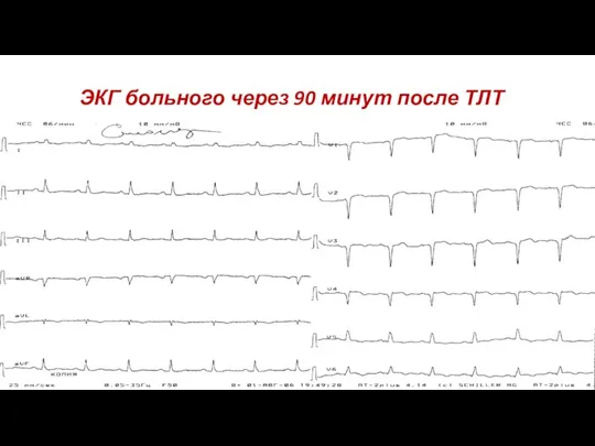 ЭКГ больного через 90 минут после ТЛТ