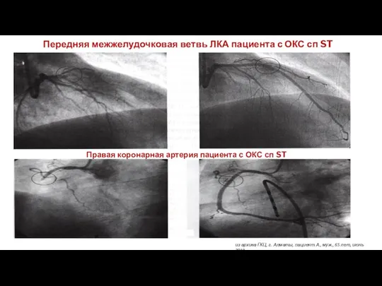 Передняя межжелудочковая ветвь ЛКА пациента с ОКС сп ST Правая коронарная