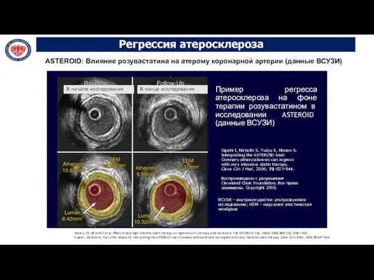 Пример регресса атеросклероза на фоне терапии розувастатином в исследовании ASTEROID (данные