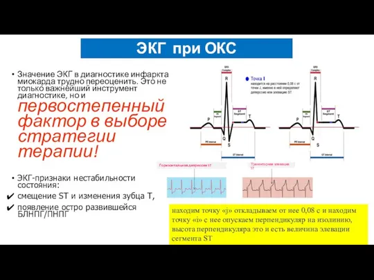 ЭКГ при ОКС Значение ЭКГ в диагностике инфаркта миокарда трудно переоценить.