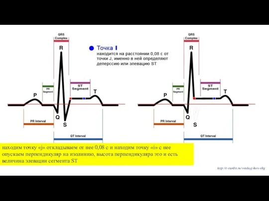 http://e-cardio.ru/vvodnyj-kurs-ekg находим точку «j» откладываем от нее 0,08 с и находим