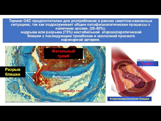 Атеросклеротическая бляшка Тромбоз Фиброзная ткань Липидное тело Фатальный тромб Разрыв бляшки