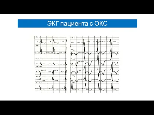 ЭКГ пациента с ОКС