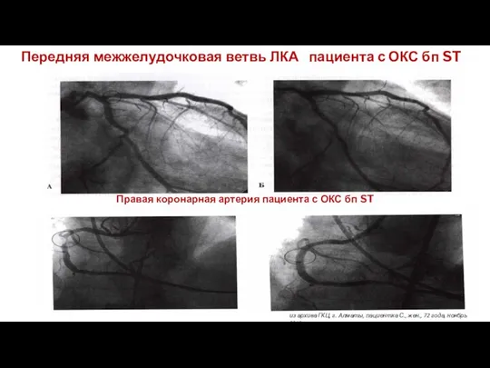 Передняя межжелудочковая ветвь ЛКА пациента с ОКС бп ST Правая коронарная