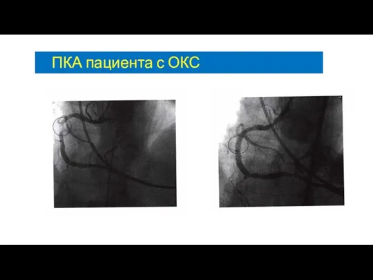 ПКА пациента с ОКС