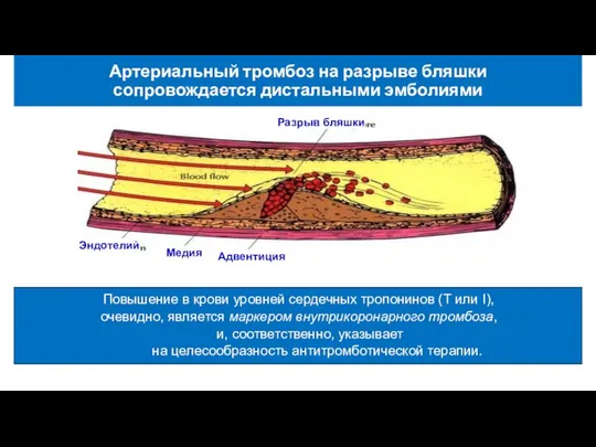 Артериальный тромбоз на разрыве бляшки сопровождается дистальными эмболиями Разрыв бляшки Адвентиция