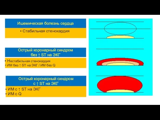 P.Theroux, XX Конгресс ЕКО, Вена, 1998 Острый коронарный синдром без ↑