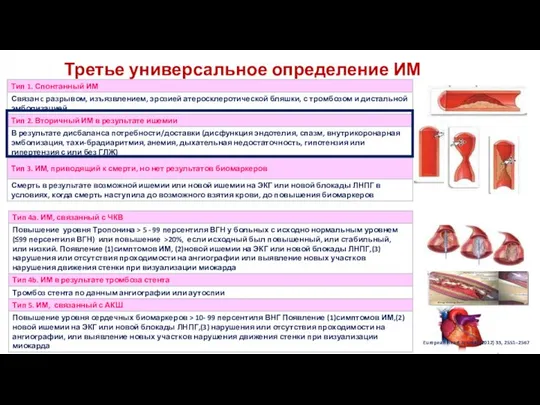 Третье универсальное определение ИМ European Heart Journal (2012) 33, 2551–2567