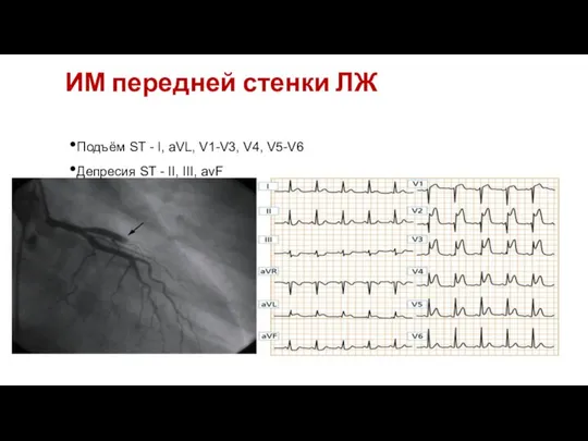 17 17 17 Подъём ST - I, aVL, V1-V3, V4, V5-V6