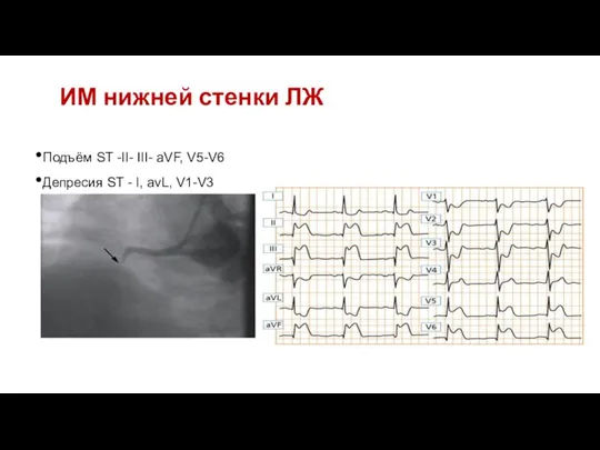 19 19 19 Подъём ST -II- III- aVF, V5-V6 Депресия ST