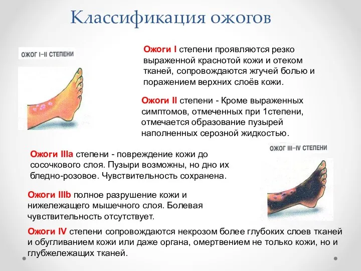 Ожоги I степени проявляются резко выраженной краснотой кожи и отеком тканей,