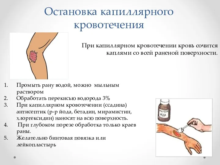 Остановка капиллярного кровотечения Промыть рану водой, можно мыльным раствором Обработать перекисью