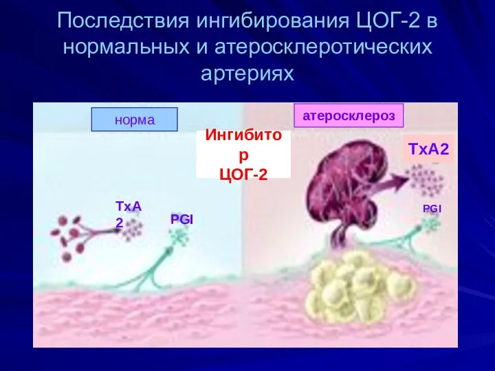 Последствия ингибирования ЦОГ-2 в нормальных и атеросклеротических артериях норма атеросклероз Ингибитор ЦОГ-2 PGI TxA2 TxA2 PGI