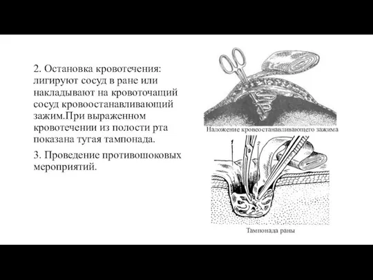 2. Остановка кровотечения: лигируют сосуд в ране или накладывают на кровоточащий