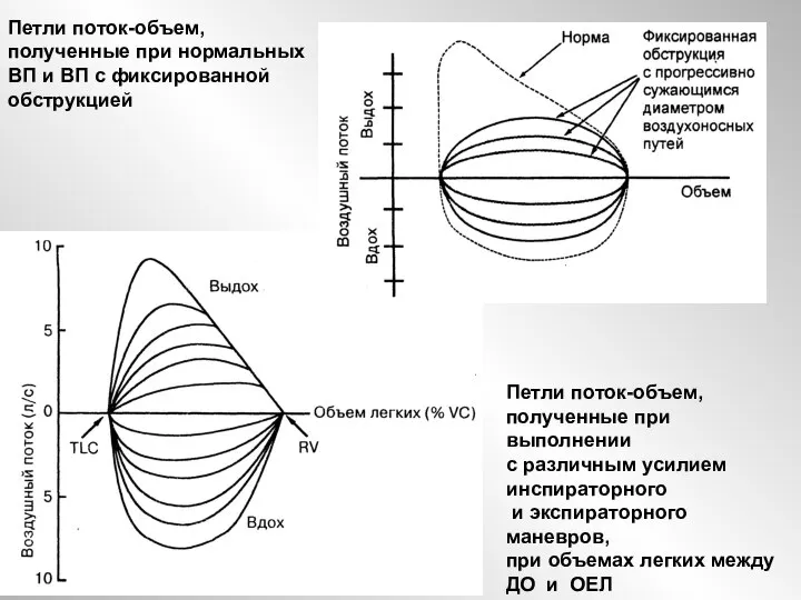 Петли поток-объем, полученные при нормальных ВП и ВП с фиксированной обструкцией