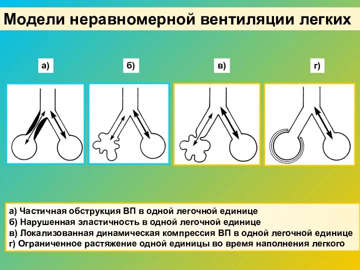 Модели неравномерной вентиляции легких а) Частичная обструкция ВП в одной легочной