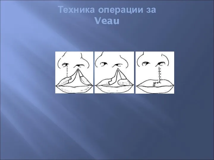 Техника операции за Veau