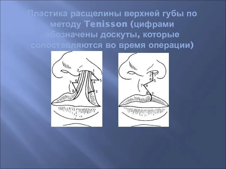 Пластика расщелины верхней губы по методу Tenisson (цифрами обозначены доскуты, которые сопоставляются во время операции)