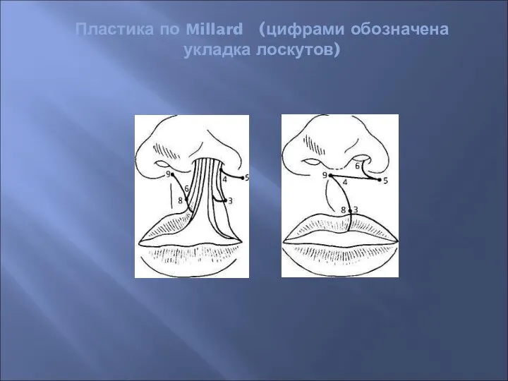 Пластика по Millard (цифрами обозначена укладка лоскутов)