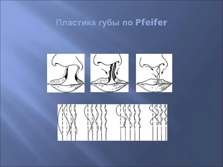 Пластика губы по Pfeifer