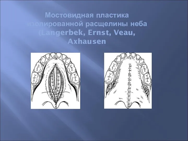 Мостовидная пластика изолированной расщелины неба (Langerbek, Ernst, Veau, Axhausen