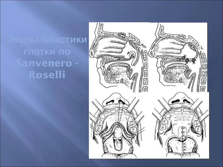 Этапы пластики глотки по Sanvenero - Roselli