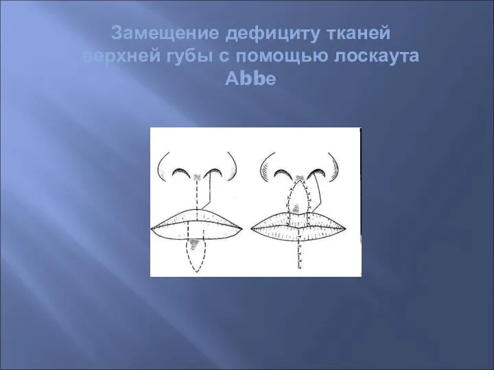 Замещение дефициту тканей верхней губы с помощью лоскаута Аbbе