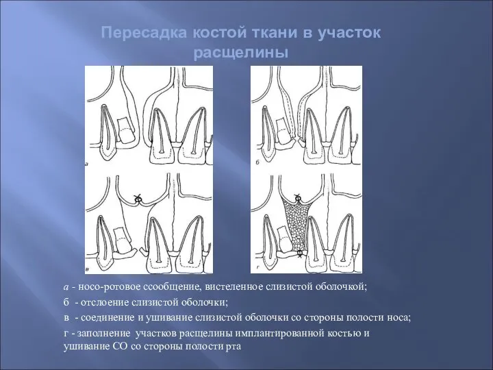 Пересадка костой ткани в участок расщелины а - носо-ротовое ссообщение, вистеленное