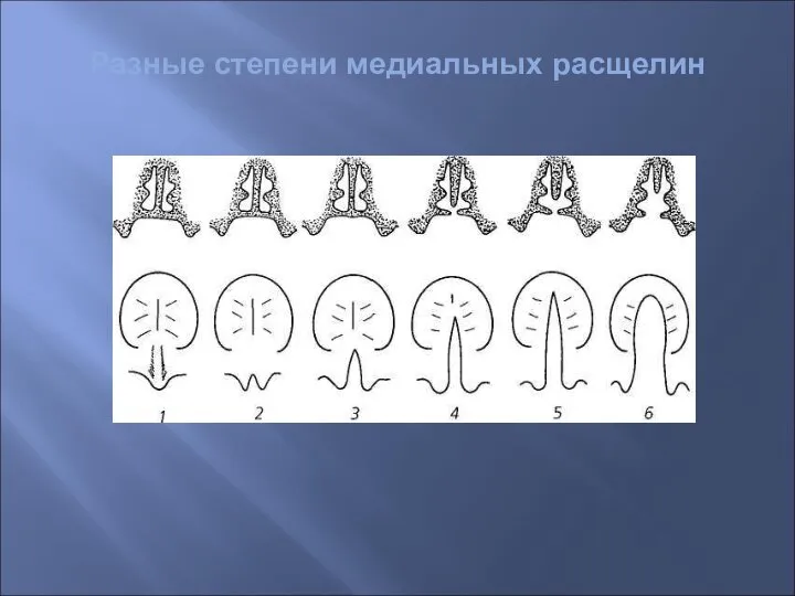 Разные степени медиальных расщелин