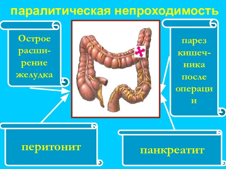 Острое расши- рение желудка панкреатит перитонит парез кишеч- ника после операции паралитическая непроходимость