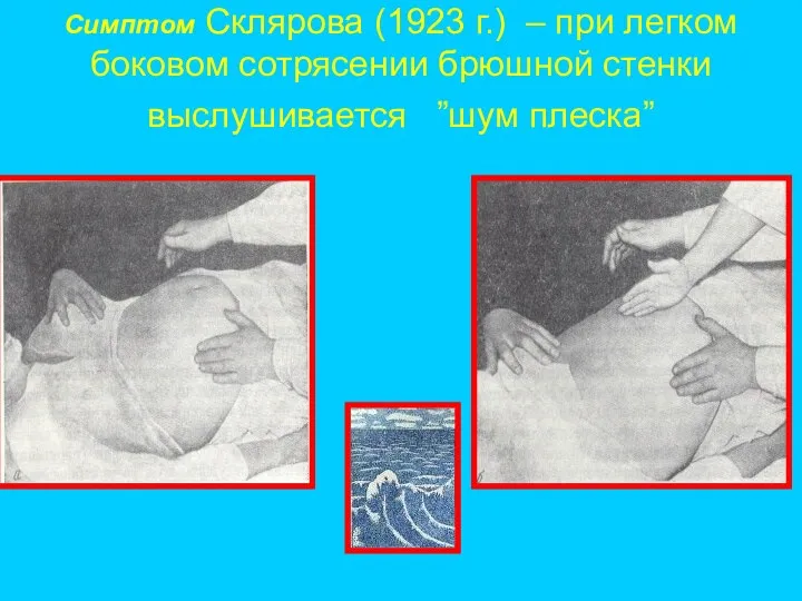 Симптом Склярова (1923 г.) – при легком боковом сотрясении брюшной стенки выслушивается ”шум плеска”