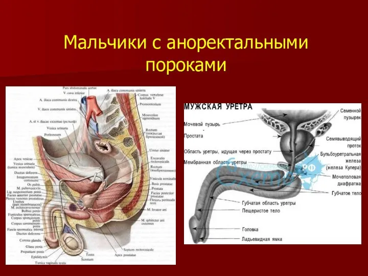 Мальчики с аноректальными пороками