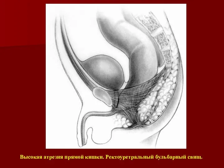 Высокая атрезия прямой кишки. Ректоуретральный бульбарный свищ.