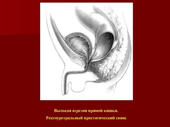 Высокая атрезия прямой кишки. Ректоуретральный простатический свищ