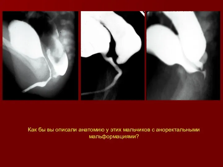 Как бы вы описали анатомию у этих мальчиков с аноректальными мальформациями?