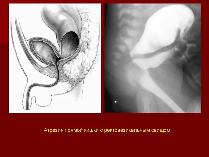 Атрезия прямой кишки с ректовезикальным свищом