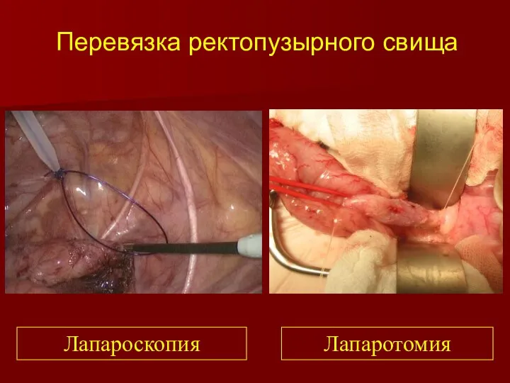 Перевязка ректопузырного свища Лапароскопия Лапаротомия