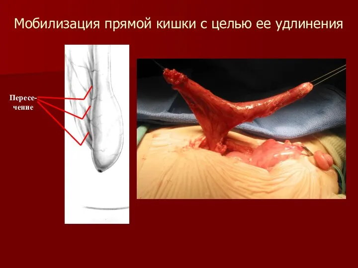 Мобилизация прямой кишки с целью ее удлинения