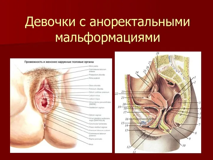 Девочки с аноректальными мальформациями