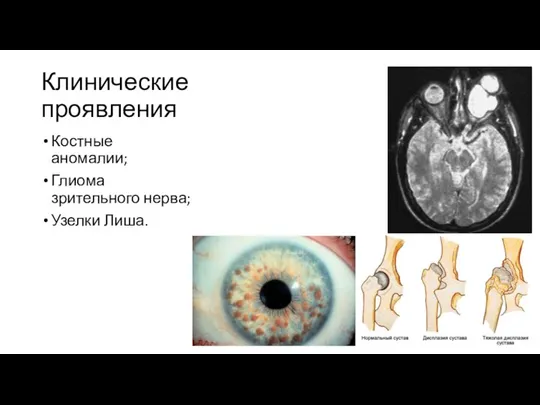 Клинические проявления Костные аномалии; Глиома зрительного нерва; Узелки Лиша.