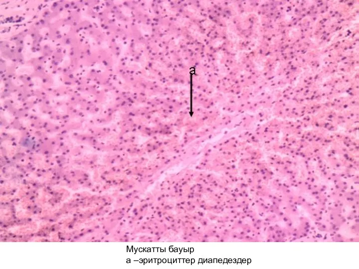 Мускатты бауыр а –эритроциттер диапедездер