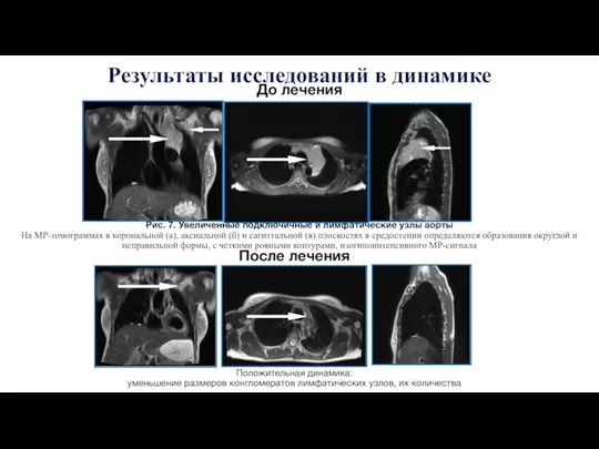 Результаты исследований в динамике Рис. 7. Увеличенные подключичные и лимфатические узлы