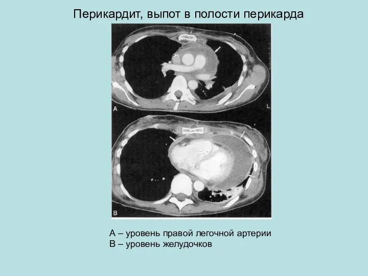 Перикардит, выпот в полости перикарда А – уровень правой легочной артерии В – уровень желудочков