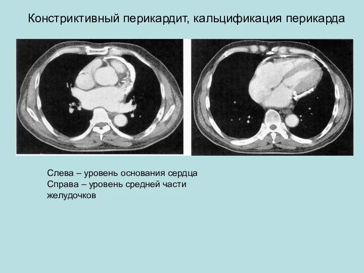 Констриктивный перикардит, кальцификация перикарда Слева – уровень основания сердца Справа – уровень средней части желудочков