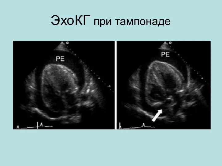 ЭхоКГ при тампонаде