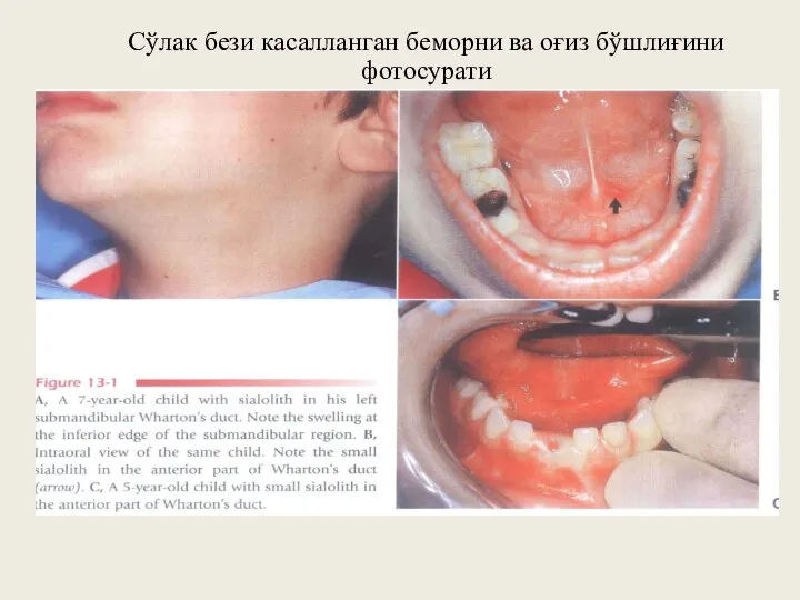 Сўлак бези касалланган беморни ва оғиз бўшлиғини фотосурати