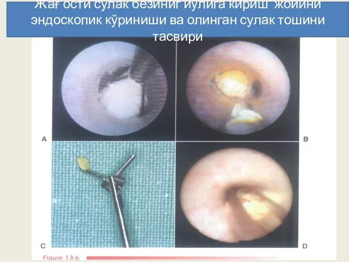 Жағ ости сулак безиниг йўлига кириш жойини эндоскопик кўриниши ва олинган сулак тошини тасвири