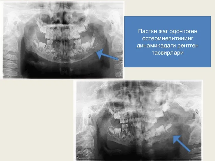www.themegallery.com Пастки жағ одонтоген остеомиелитининг динамикадаги рентген тасвирлари